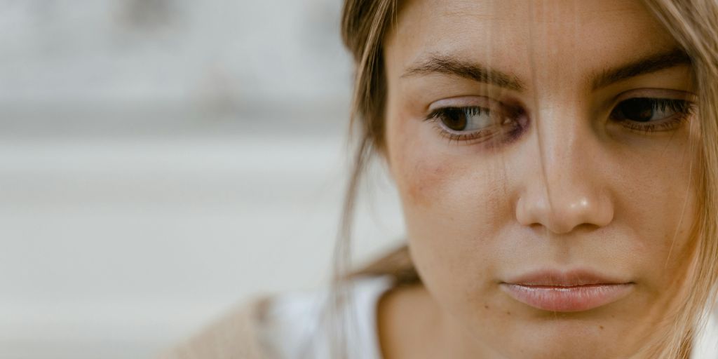 Orbital fat loss after weight loss showing sunken appearance around the eyes